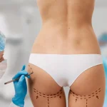 Gluteoplastia: cuidados, técnicas e mitos